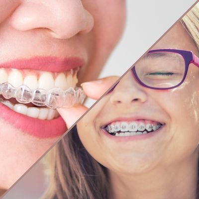 Braces vs. Clear Aligners: What's the Difference?