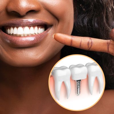 Dental Implants in Newmarket Dental